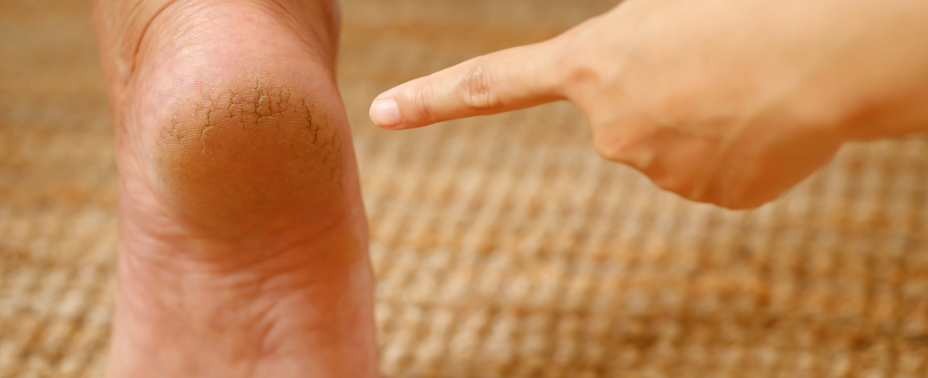 Supplément : Calluspeeling Végétal – Douceur &amp; Pieds Parfaits